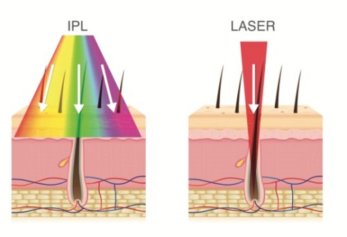 diferencia entre depilaci�n ipl y l�ser
